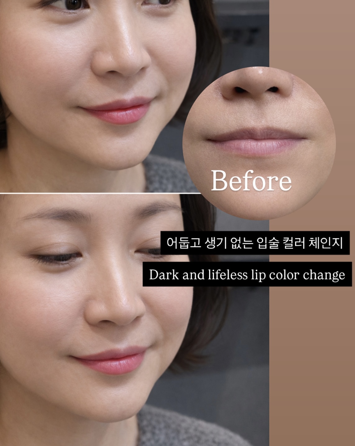 입술 시술 사진 15